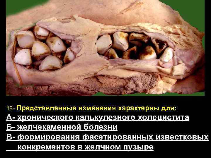 18 - Представленные изменения характерны для: А- хронического калькулезного холецистита Б- желчекаменной болезни В-