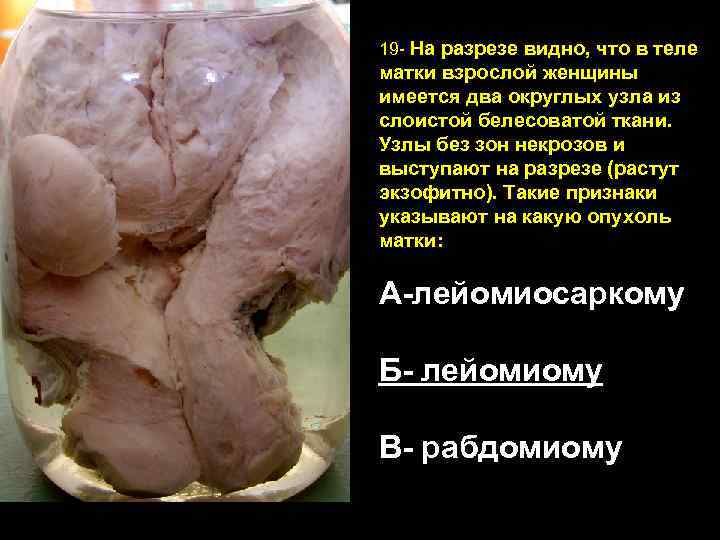 19 - На разрезе видно, что в теле матки взрослой женщины имеется два округлых