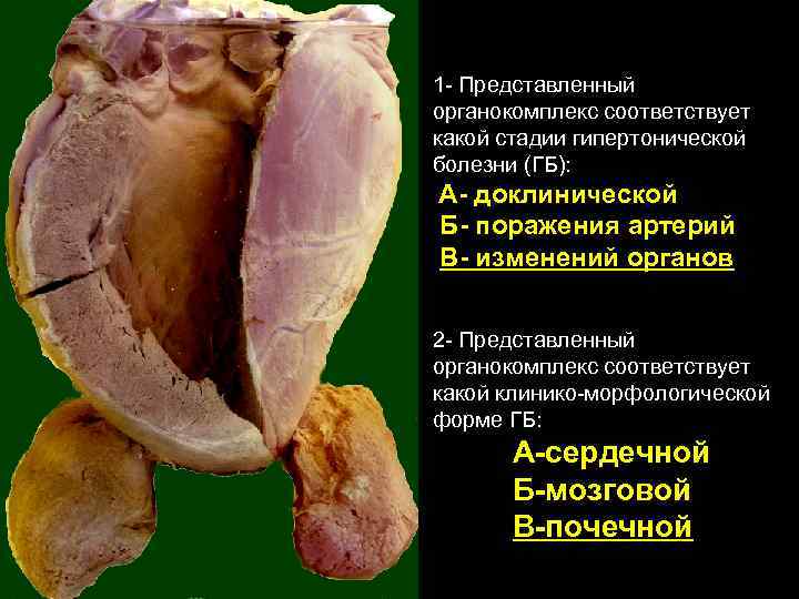 1 - Представленный органокомплекс соответствует какой стадии гипертонической болезни (ГБ): А- доклинической Б- поражения