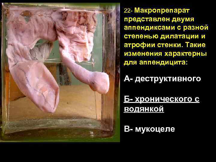 22 - Макропрепарат представлен двумя аппендиксами с разной степенью дилатации и атрофии стенки. Такие
