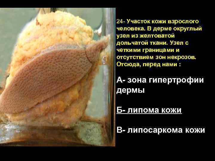 24 - Участок кожи взрослого человека. В дерме округлый узел из желтоватой дольчатой ткани.