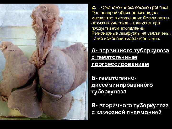 25 – Органокомплекс органов ребенка. Под плеврой обеих легких видно множество выступающих белесоватых округлых