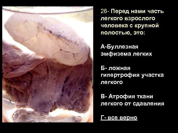 26 - Перед нами часть легкого взрослого человека с крупной полостью, это: А-Буллезная эмфизема