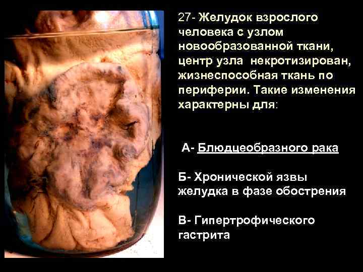 27 - Желудок взрослого человека с узлом новообразованной ткани, центр узла некротизирован, жизнеспособная ткань
