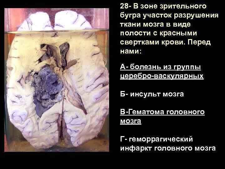 28 - В зоне зрительного бугра участок разрушения ткани мозга в виде полости с