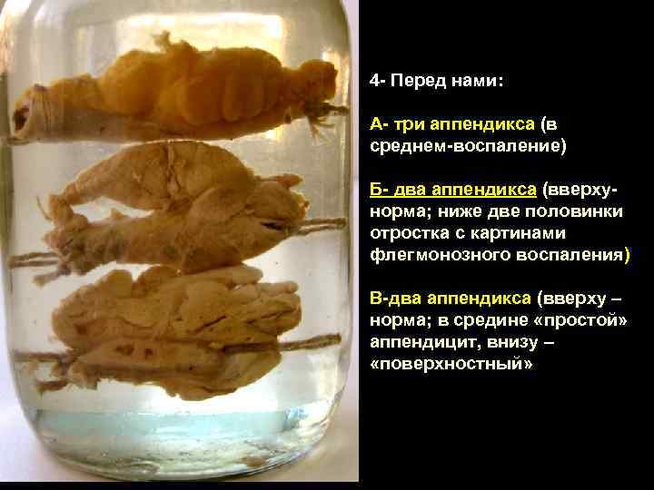 4 - Перед нами: А- три аппендикса (в среднем-воспаление) Б- два аппендикса (вверхунорма; ниже