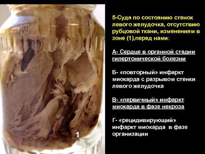 5 -Судя по состоянию стенок левого желудочка, отсутствию рубцовой ткани, изменениям в зоне (1),