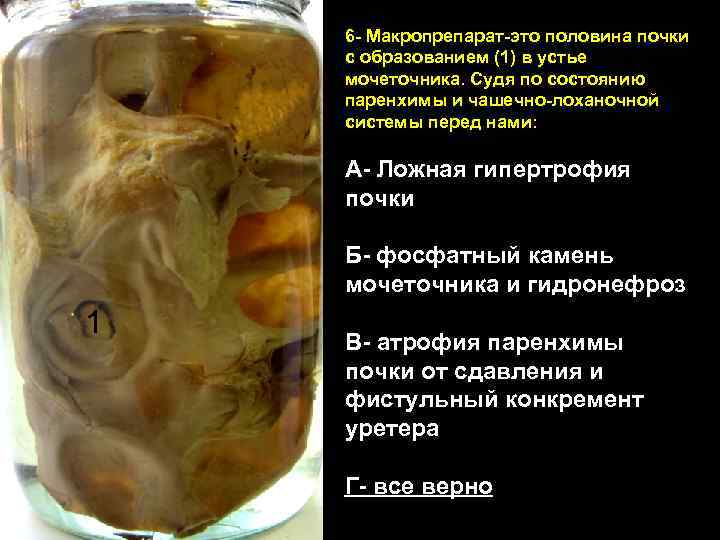 6 - Макропрепарат-это половина почки с образованием (1) в устье мочеточника. Судя по состоянию