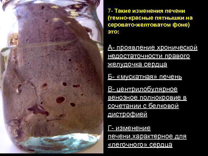 7 - Такие изменения печени (темно-красные пятнышки на серовато-желтоватом фоне) это: А- проявление хронической