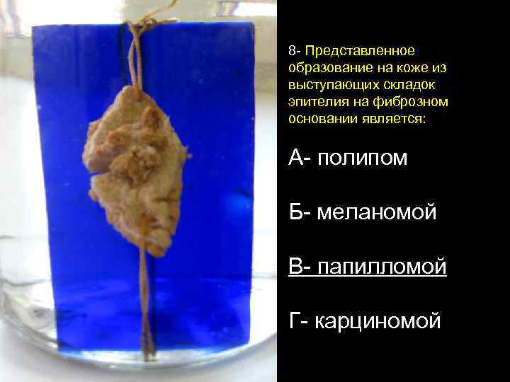 8 - Представленное образование на коже из выступающих складок эпителия на фиброзном основании является: