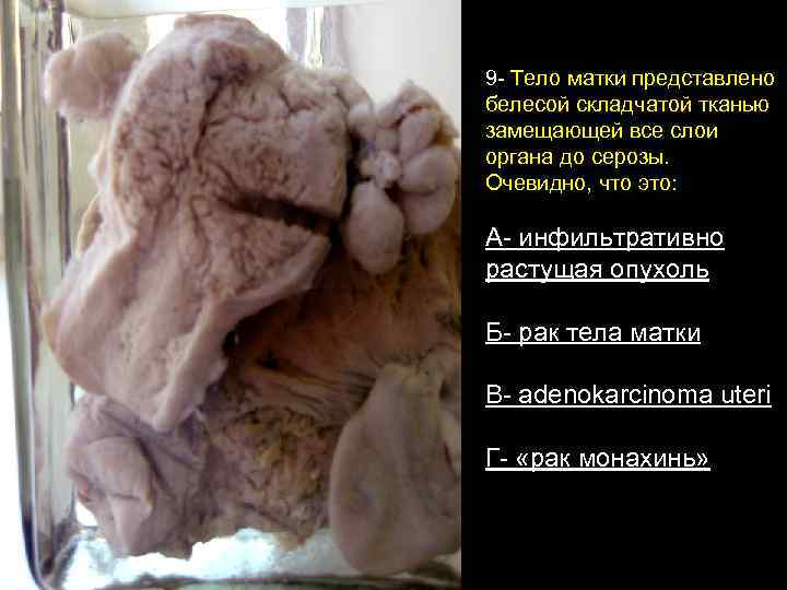 9 - Тело матки представлено белесой складчатой тканью замещающей все слои органа до серозы.