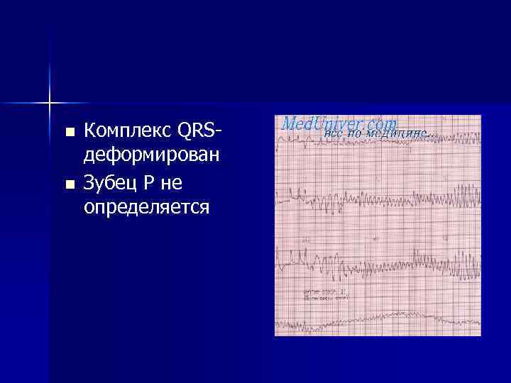 n n Комплекс QRS- деформирован Зубец Р не определяется 