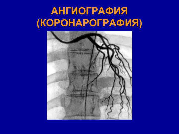 АНГИОГРАФИЯ (КОРОНАРОГРАФИЯ) 