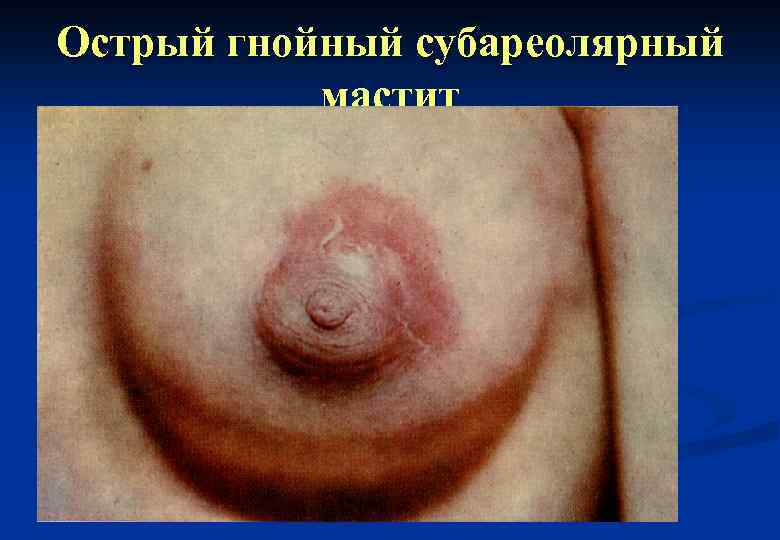 Острый гнойный субареолярный мастит 