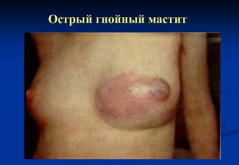 Острый гнойный мастит 