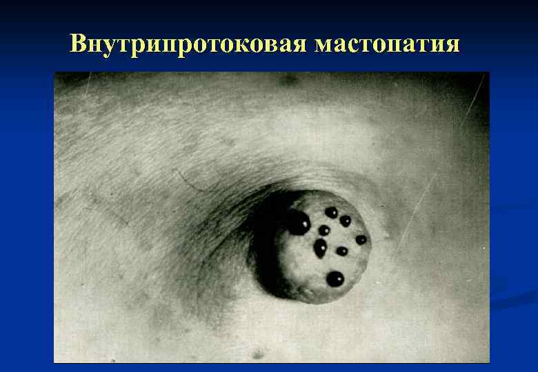 Внутрипротоковая мастопатия 