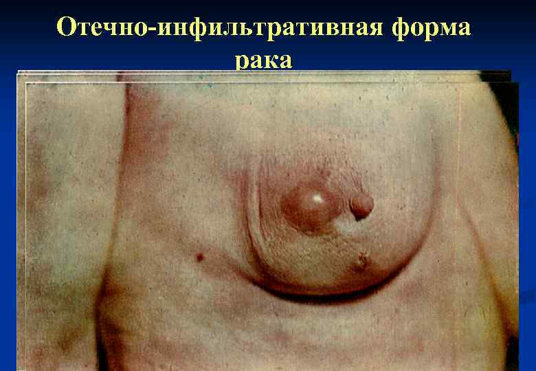 Отечно-инфильтративная форма рака 