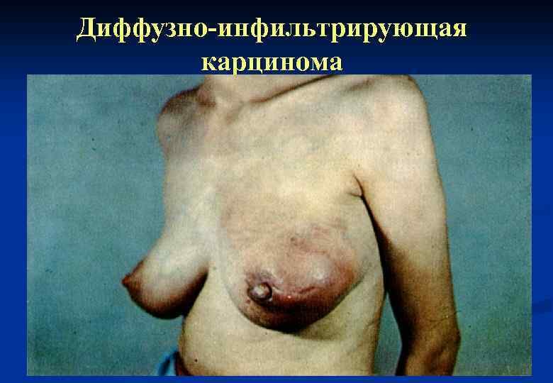 Диффузно-инфильтрирующая карцинома 