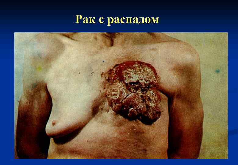 Рак с распадом 