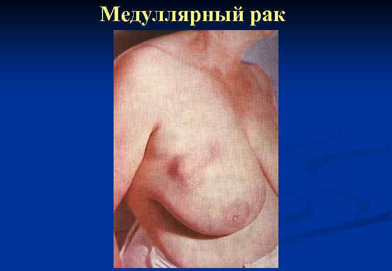 Медуллярный рак 