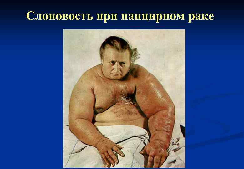 Слоновость при панцирном раке 