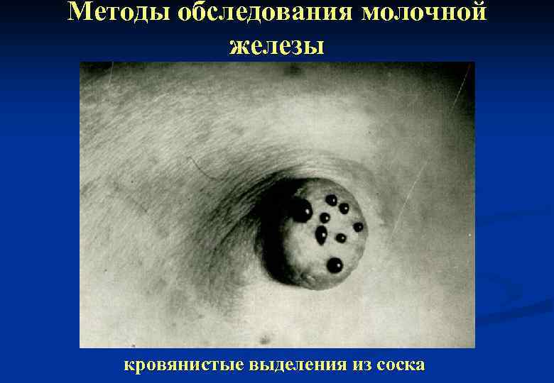 Методы обследования молочной железы кровянистые выделения из соска 