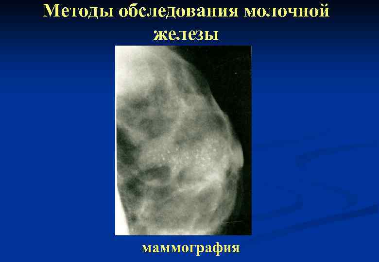 Методы обследования молочной железы маммография 