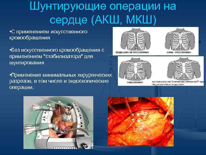 Шунтирующие операции на сердце (АКШ, МКШ) • С применением искусственного кровообращения • Без искусственного
