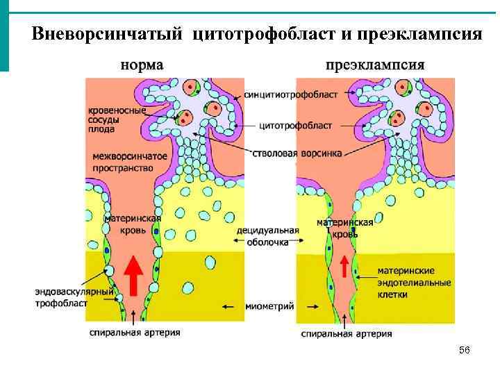 Вневорсинчатый цитотрофобласт и преэклампсия 56 
