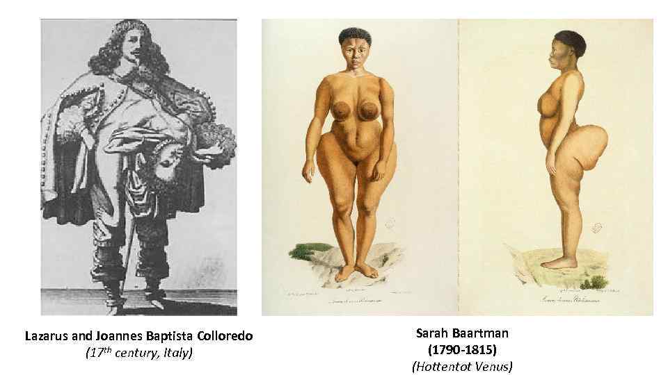 Lazarus and Joannes Baptista Colloredo (17 th century, Italy) Sarah Baartman (1790 -1815) (Hottentot