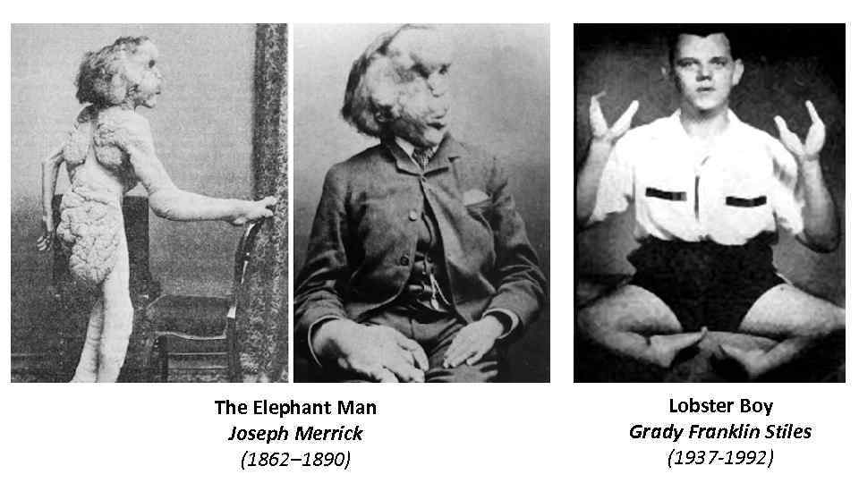 The Elephant Man Joseph Merrick (1862– 1890) Lobster Boy Grady Franklin Stiles (1937 -1992)