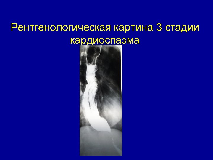 Рентгенологическая картина 3 стадии кардиоспазма 