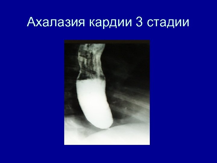 Ахалазия кардии 3 стадии 