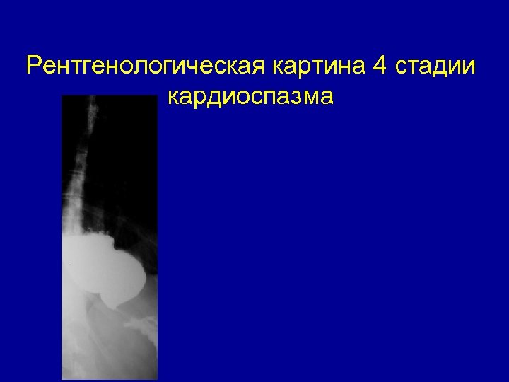 Рентгенологическая картина 4 стадии кардиоспазма 