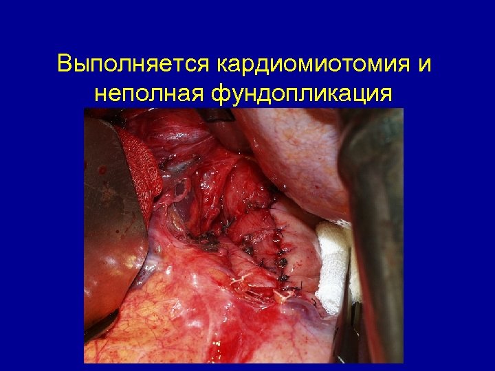 Выполняется кардиомиотомия и неполная фундопликация 