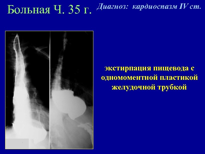 Больная Ч. 35 г. Диагноз: кардиоспазм IV ст. экстирпация пищевода с одномоментной пластикой желудочной