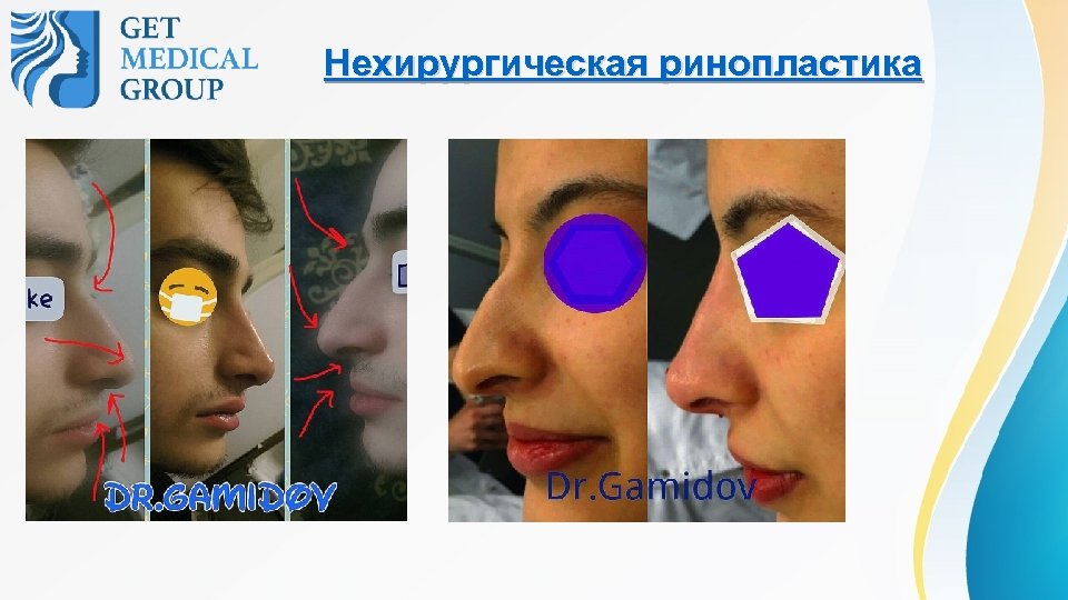 Нехирургическая ринопластика 