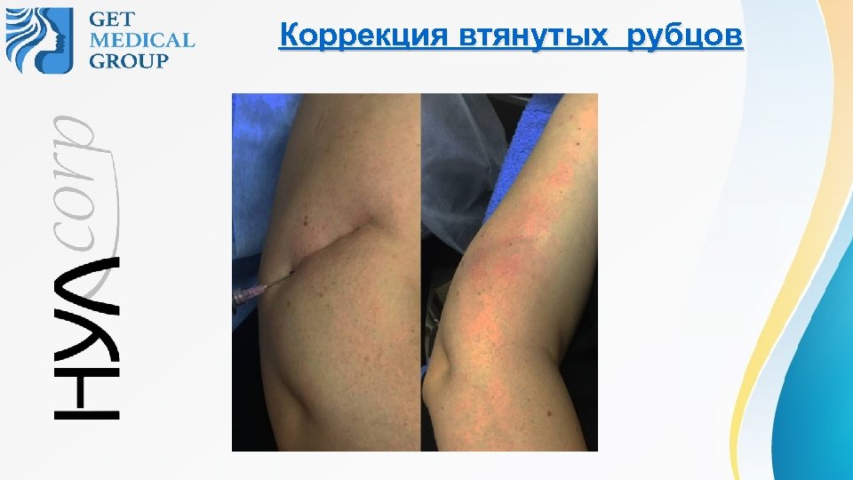 Коррекция втянутых рубцов 