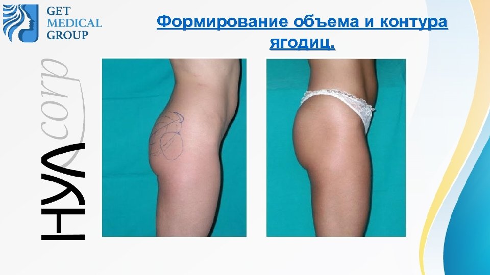 Формирование объема и контура ягодиц. 