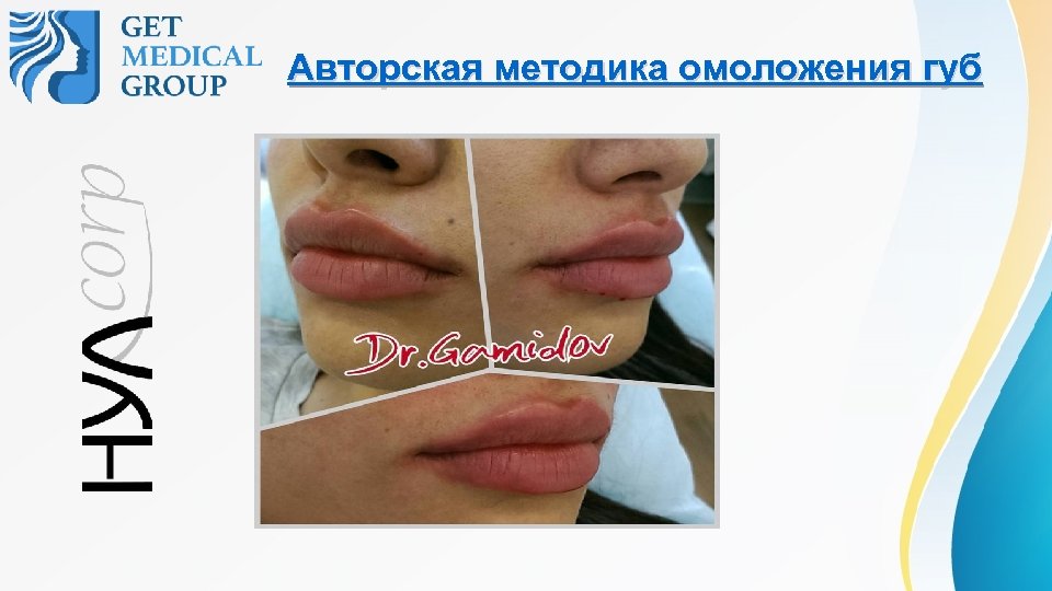Авторская методика омоложения губ 
