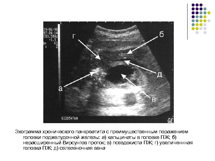 Эхограмма хронического панкреатита с преимущественным поражением головки поджелудочной железы: а) кальцинаты в головке