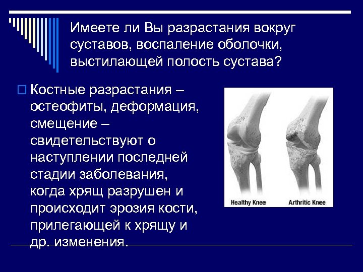 Имеете ли Вы разрастания вокруг суставов, воспаление оболочки, выстилающей полость сустава? o Костные разрастания