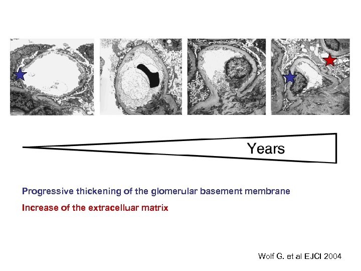Progressive thickening of the glomerular basement membrane Increase of the extracelluar matrix Wolf G.