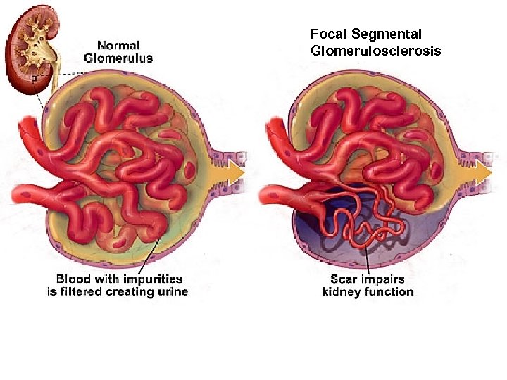 Focal Segmental Glomerulosclerosis 