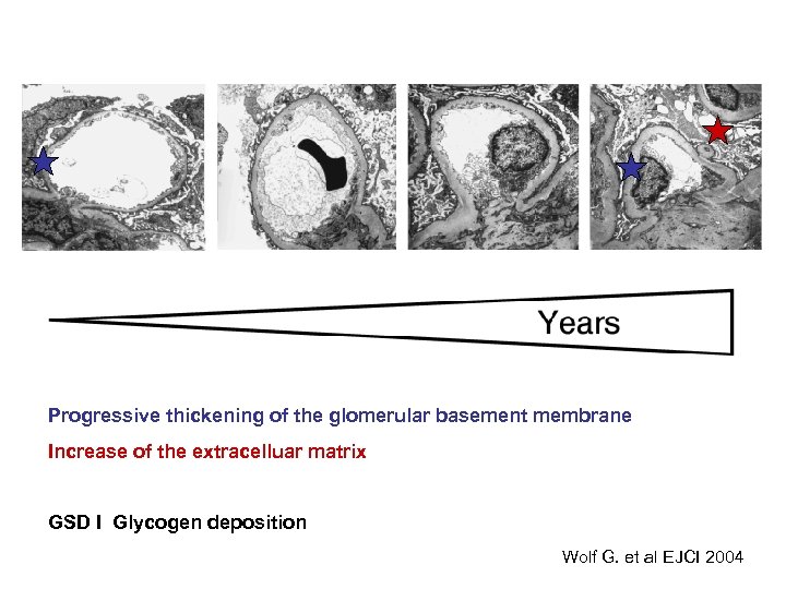 Progressive thickening of the glomerular basement membrane Increase of the extracelluar matrix GSD I