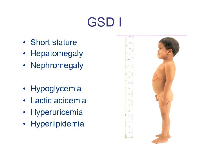 GSD I • Short stature • Hepatomegaly • Nephromegaly • • Hypoglycemia Lactic acidemia