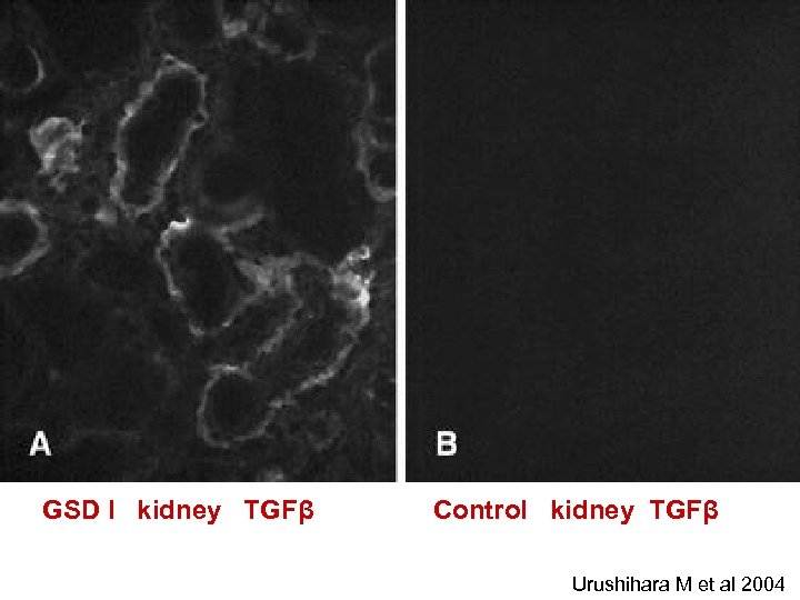 GSD I kidney TGFβ Control kidney TGFβ Urushihara M et al 2004 
