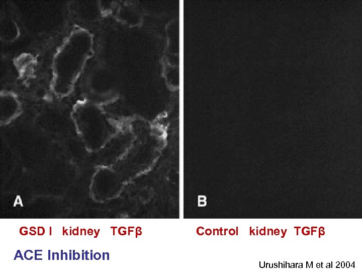GSD I kidney TGFβ ACE Inhibition Control kidney TGFβ Urushihara M et al 2004