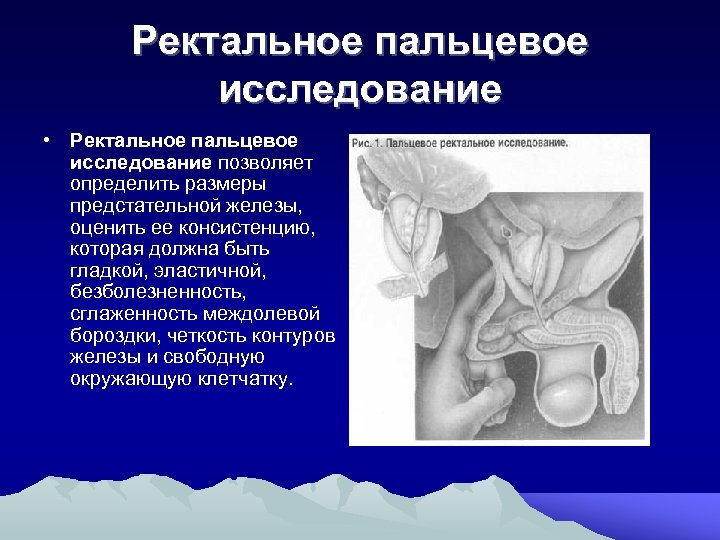 Ректальное пальцевое исследование • Ректальное пальцевое исследование позволяет определить размеры предстательной железы, оценить ее
