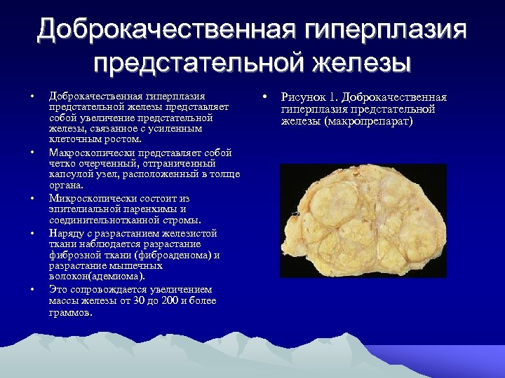 Доброкачественная гиперплазия предстательной железы • • • Доброкачественная гиперплазия предстательной железы представляет собой увеличение